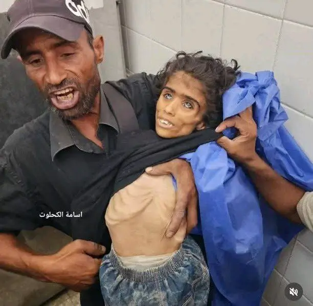 Emaciated child of Gaza named Baraa Abu Sila, victim of starvation due to Israeli-American blockade.